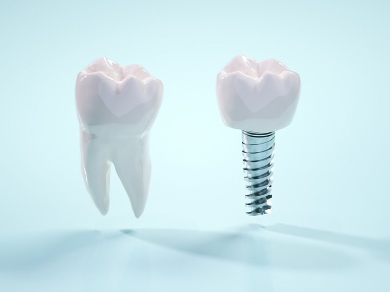 インプラントとは