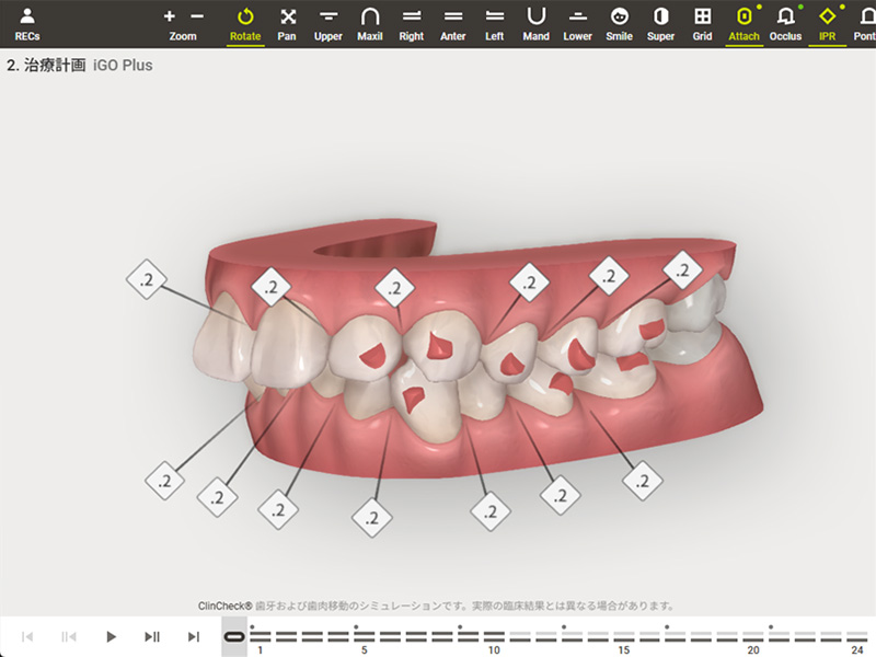 クリンチェック（治療計画の説明）
